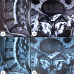 MRI images of herniated disc